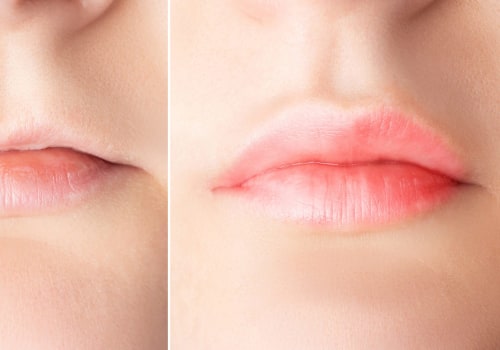 What happens to lip fillers as you age?