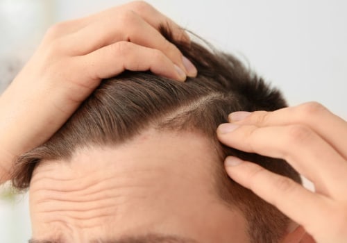 A Complete Guide to Finasteride for Hair Loss Treatment