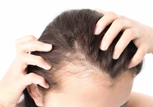 Hormonal Imbalances and Hair Loss: Understanding the Link