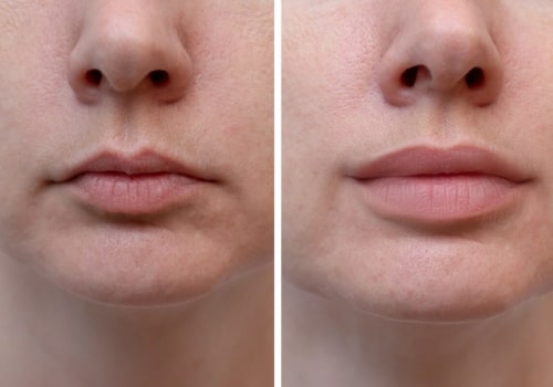 What is the minimum amount of lip fillers?