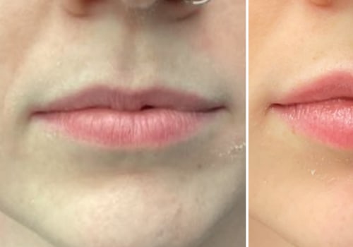 How long do lip fillers last first time?