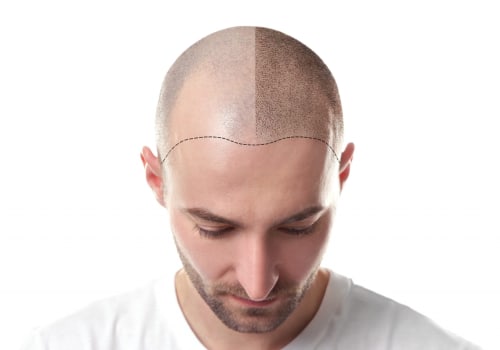 Scalp Camouflage Techniques: Enhancing Your Look