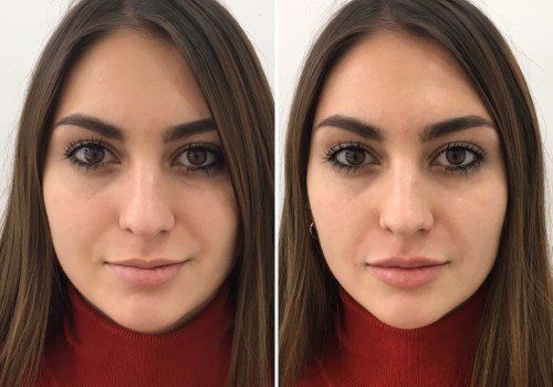 How long does it take for lip fillers to look good?