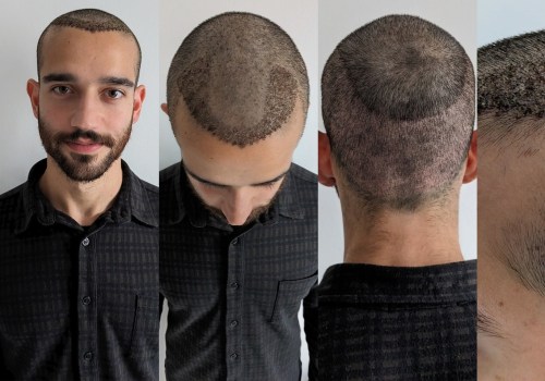 All You Need to Know About Hair Transplants