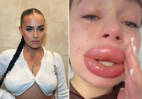 Do lip fillers cause saggy lips?