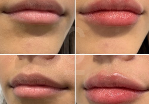 Do lip fillers cause wrinkles?