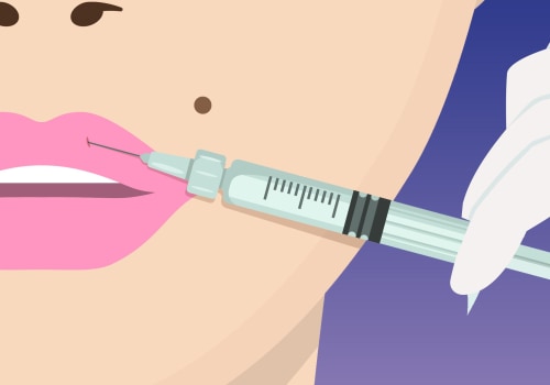 All You Need to Know About Syringe Injections for Lip Fillers