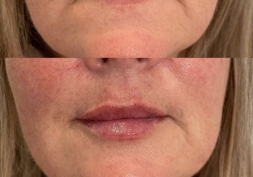 What is the best age to get lip fillers?